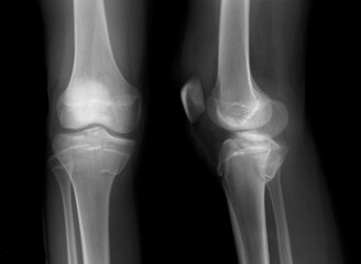 x ray of a tibial plateu fracture knee