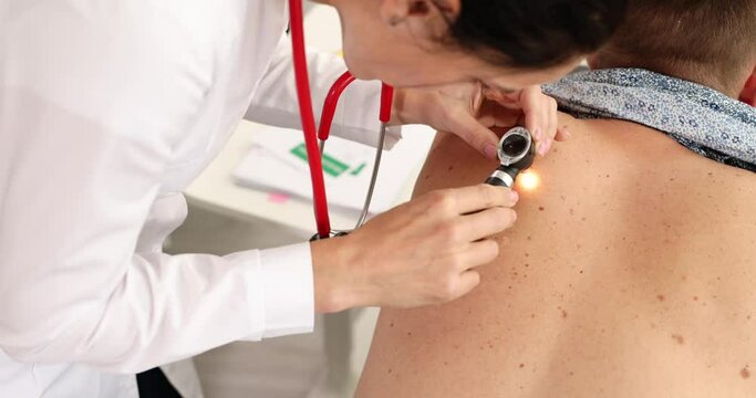 Doctor oncologist examining patient pigmented nevus using dermatoscope 4k movie