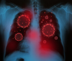 coronaviruses influenza COVID-19  X-ray film Used in medicine 3d rendering.