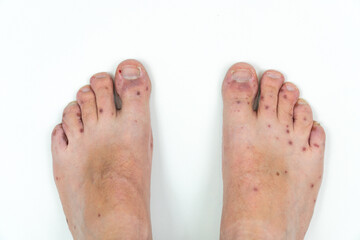 Fototapeta premium Human legs with dermatitis, allergy rash. Close up of male's foot and toes with red rash desease. Enterovirus. Coxsackie virus. Allergic rash on the legs of an adult man