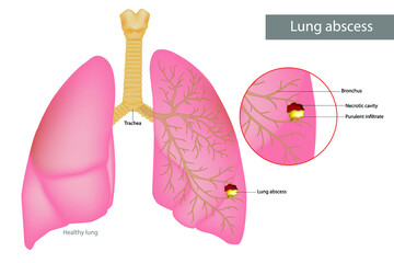 Lung abscess is a type of liquefactive necrosis of the lung tissue. Purulent infiltrate and Necrotic cavity in the lungs. Lungs disease necrotizing pneumonia - obrazy, fototapety, plakaty