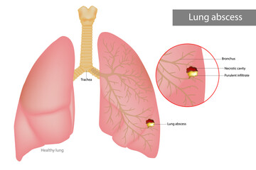 Lung abscess is a type of liquefactive necrosis of the lung tissue. Purulent infiltrate and Necrotic cavity in the lungs. Lungs disease necrotizing pneumonia - obrazy, fototapety, plakaty
