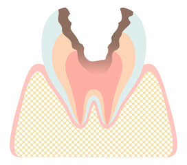 虫歯になった歯の断面（C3） - obrazy, fototapety, plakaty