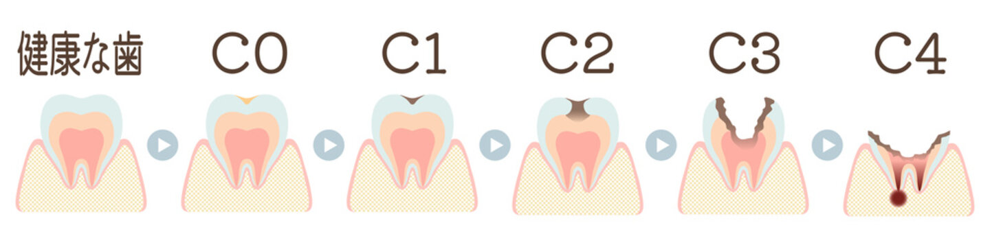 虫歯になる過程（Co～C4）