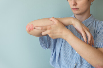 Woman with psoriasis. Health allergy skin care problem, Psoriasis vulgaris. Joints affected by...