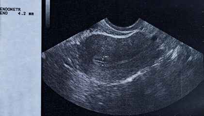 Ultrasound of a woman's uterus showing the size of the endometrium