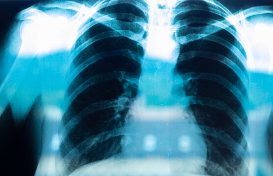 Chest radiography, lung x-ray after a covid 19 infection
