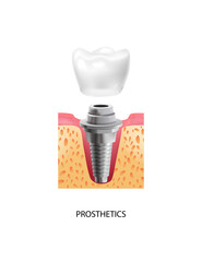 Dental Implantation Prosthetics Composition