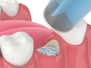3D render of dental bone grafting with dental bone biomaterial application