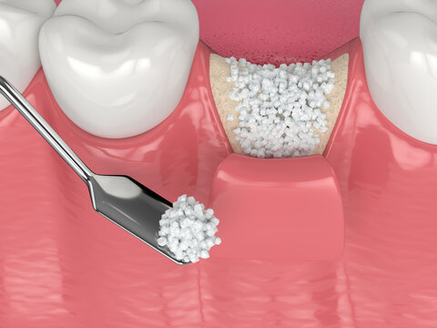 3D Render Of Dental Bone Grafting With Bone Biomaterial Application