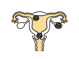 シンプル　イラスト　子宮　がんの発生部位