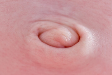 Healing navel of a newborn baby after a dropped umbilical cord - obrazy, fototapety, plakaty