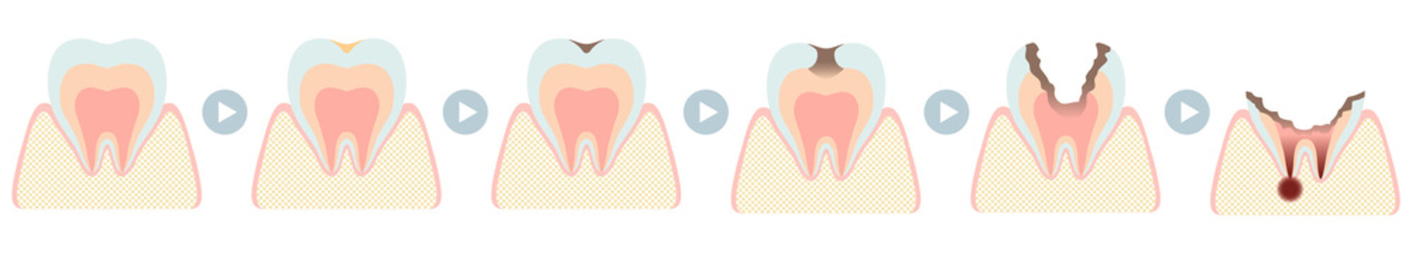 虫歯になる過程（C0～C4）
