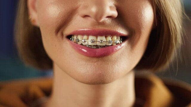 Woman smile with braces close-up, young female person smiling. Model posing close-up of face. Beautiful skin, natural make-up, orthodontics concept. 