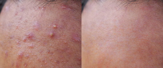 Image before and after acne treatment on the face of young Asian men. Problem skin and beauty...