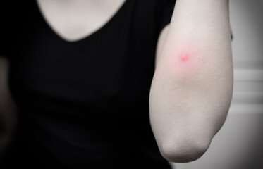 The inflammation of the swelling from abscess near woman’s elbow. Selective focus. Black and...