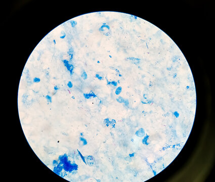 Bacteria Mycobacterium tuberculosis, the causative agent of tuberculosis, can be used for M. leprae, M. avium complex and other mycobacteria, Sputum Ziehl-Neelsen (ZN) stained AFB micrograph