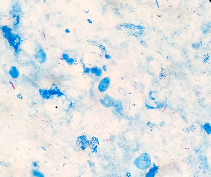 Bacteria Mycobacterium tuberculosis, the causative agent of tuberculosis, can be used for M. leprae, M. avium complex and other mycobacteria, Sputum Ziehl-Neelsen (ZN) stained AFB micrograph