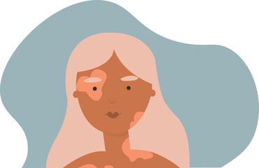 World vitiligo day. Woman with skin pigmentation vector. Flat graphic. 