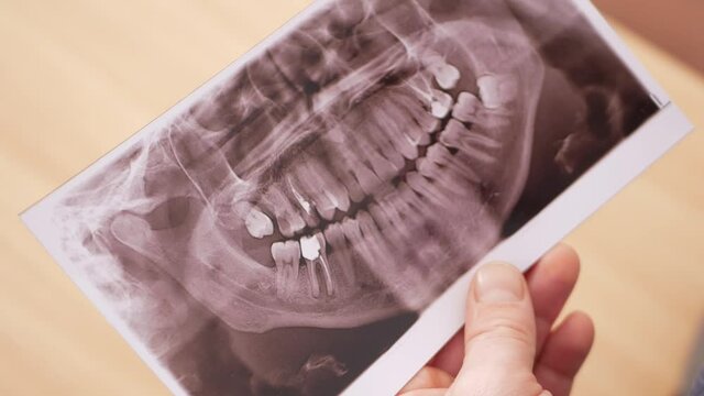 Medical x-ray of teeth, dentist's office. Teeth with crowns, fillings, oral problems. Treatment, teeth fall out, deteriorate, age. Holes in the tooth. a man holds a picture
