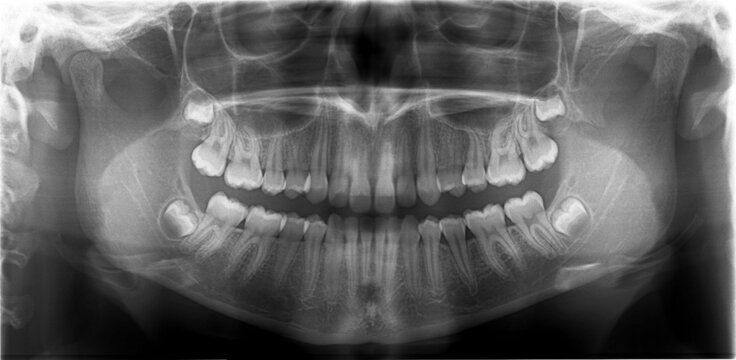 dental x ray image of child 