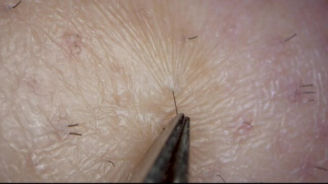 This macro, super close up video shows tweezer pulling and plucking a hair from skin.