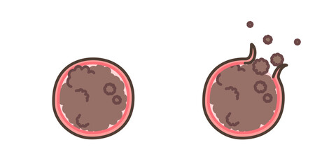 乳がんの乳管断面図