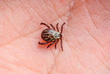 Infectious Encephalitis Tick Insect on Skin. Encephalitis Virus or Lyme Borreliosis Disease Infected Dermacentor Tick Arachnid Parasite Bite Close-up.