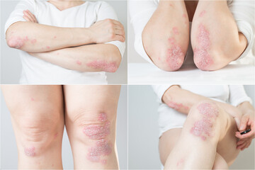 Multiphoto, collage of acute poriasis in various parts of the female body. An autoimmune, incurable dermatological skin disease. Large red, inflamed, scaly rash