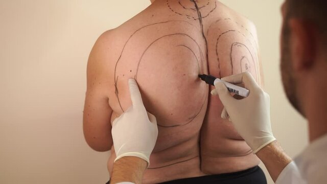 Markup for liposuction surgery. Kyphosis. Removing dowager hump. Obesity of woman.