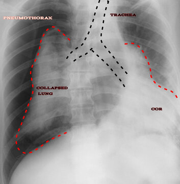 Xray image of pneumothorax vector