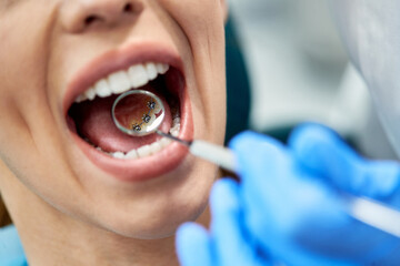 Close-up of woman during inner dental braces check-up at dentist's office.
