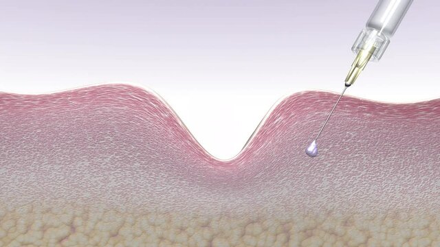 Skin rejuvenation with hyaluronic acid fillers. Injection of the drug stimulates collagen synthesis and reduces wrinkles.3D animation ad for anti-aging treatment, spa procedures, Radiesse drug