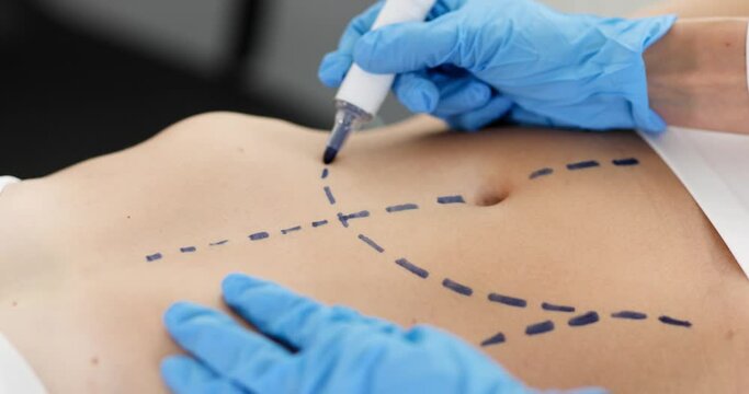 Doctor plastic surgeon drawing preoperative markings on skin of patient abdomen 4k movie