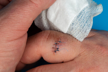 Postoperative sutures on the finger of the hand.. Stitches on the injured finger. Photo taken under...