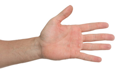 Man suffering from calluses on hand against white background, closeup