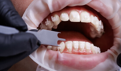 Close up of orthodontist using aluminum bracket gauge while attaching braces to patient teeth....