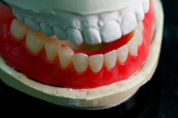 Dentistry. removable denture for the lower jaw. close-up