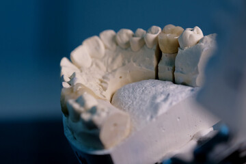 Dentistry. metal-ceramic dental crown on a plaster cast. close-up
