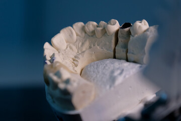 Dentistry. metal-ceramic dental crown on a plaster cast. close-up