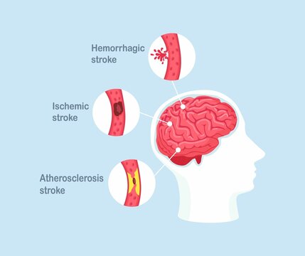 Types of human brain stroke. Ischemic, atherosclerosis and hemorrhagic stroke disease. Vector illustration