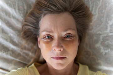 Middle-aged woman selfie seven days after Double Eyelid  blepharoplasty surgery.