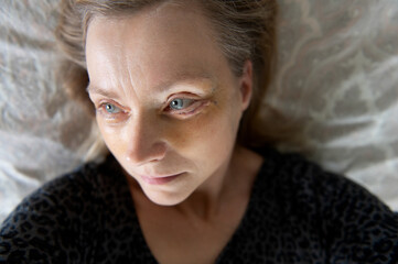 Middle-aged woman face seven days after double eyelid  blepharoplasty surgery.