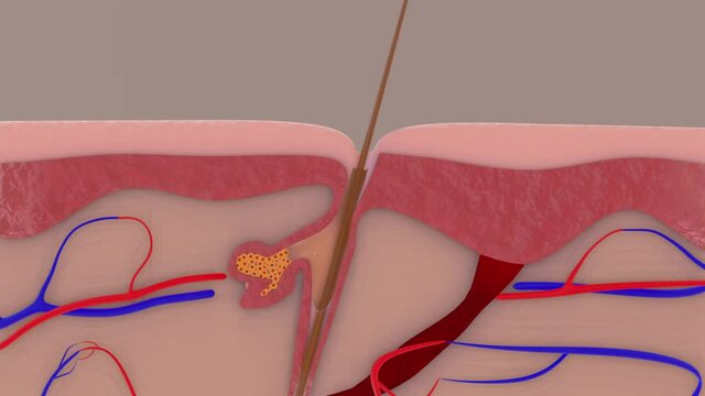 Acne animation