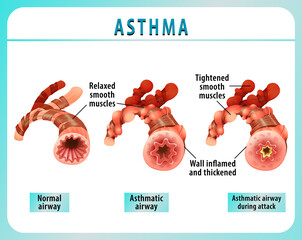 Bronchial Asthma diagram with normal airway and asthmatic airway - obrazy, fototapety, plakaty