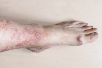 sample of Allergic contact dermatitis - male shin with redness and itchy rash on skin