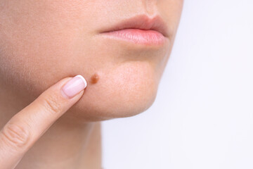 Closeup of mole on woman face. Birthmark or nevus. Copy space