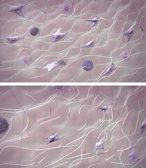 Collagen destruction process. Comparison skin extracellular matrix structure in young healthy skin and aging skin.  Medical 3D illustration
