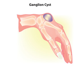 Biological illustration of ganglion cyst
