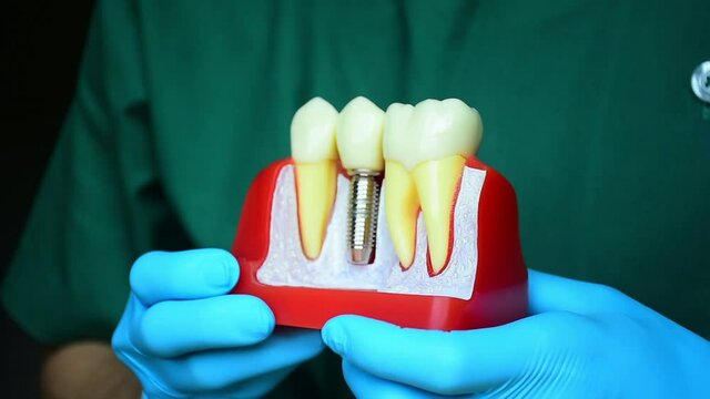 Close-up photo of implant dentistry it is a replacement for missing teeth by dentist hand.